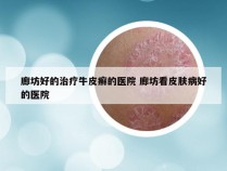 廊坊好的治疗牛皮癣的医院 廊坊看皮肤病好的医院