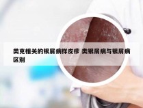 类克相关的银屑病样皮疹 类银屑病与银屑病区别
