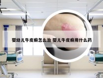 婴幼儿牛皮癣怎么治 婴儿牛皮癣用什么药