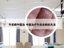 牛皮癣中医治 中医治疗牛皮皮癣的方法