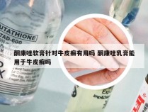酮康唑软膏针对牛皮癣有用吗 酮康唑乳膏能用于牛皮癣吗