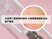 小孩得了银屑病可怕吗 小孩得银屑病长大会更严重吗