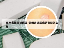 郑州市银屑病医生 郑州市银屑病研究院怎么样