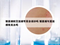 银屑病和艾滋病专家会误诊吗 银屑病与爱滋病有关糸吗