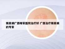 银屑病广西哪家医院治疗好 广西治疗银屑病的专家