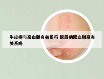 牛皮癣与高血脂有关系吗 银屑病跟血脂高有关系吗