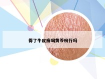 得了牛皮癣喝黄芩粉行吗