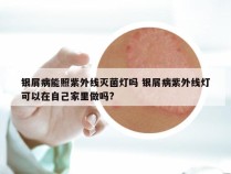 银屑病能照紫外线灭菌灯吗 银屑病紫外线灯可以在自己家里做吗?