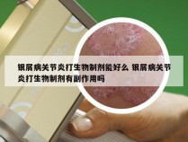 银屑病关节炎打生物制剂能好么 银屑病关节炎打生物制剂有副作用吗