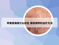 甲银屑病用什么封包 银屑病甲的治疗方法