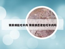 银屑病能吃羊肉 银屑病患者能吃羊肉吗