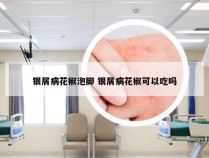 银屑病花椒泡脚 银屑病花椒可以吃吗