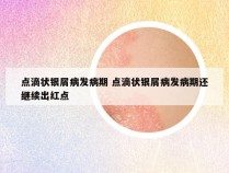 点滴状银屑病发病期 点滴状银屑病发病期还继续出红点