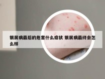 银屑病最后的危害什么症状 银屑病最终会怎么样