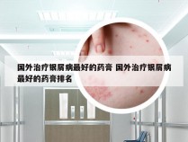 国外治疗银屑病最好的药膏 国外治疗银屑病最好的药膏排名
