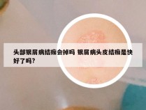 头部银屑病结痂会掉吗 银屑病头皮结痂是快好了吗?