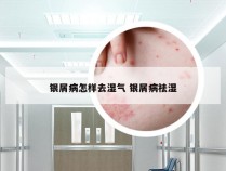 银屑病怎样去湿气 银屑病祛湿