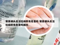 银屑病头皮活检麻醉有危害吗 银屑病头皮活检麻醉有危害吗图片