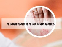 牛皮癣能吃鸡蛋吗 牛皮皮癣可以吃鸡蛋不