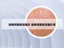 股癣初期症状图片 股癣初期症状图片男