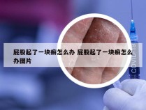 屁股起了一块癣怎么办 屁股起了一块癣怎么办图片