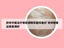 郑州中医治疗银屑病哪家医院最好 郑州哪里治银屑病好