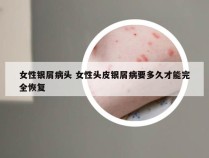女性银屑病头 女性头皮银屑病要多久才能完全恢复