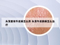 头发里有牛皮癣怎么弄 头发牛皮肤癣怎么治疗