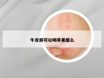 牛皮癣可以喝苹果醋么