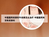 中医医院皮肤科牛皮癣怎么治疗 中医医院有没有皮肤科