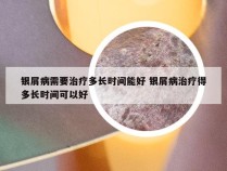 银屑病需要治疗多长时间能好 银屑病治疗得多长时间可以好