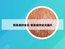 银屑病伴皮炎 银屑病伴皮炎图片