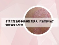 卡泊三醇治疗牛皮癣复发多久 卡泊三醇治疗银屑病多久见效