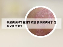 银屑病快好了看到了希望 我银屑病好了 怎么又长出来了