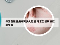 寻常型银屑病红斑多久能退 寻常型银屑病红斑变大