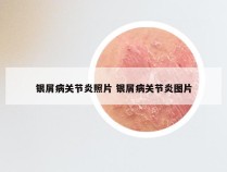 银屑病关节炎照片 银屑病关节炎图片
