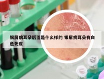 银屑病耳朵后面是什么样的 银屑病耳朵有白色死皮