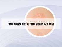 银屑病晒太阳好吗 银屑病能晒多久太阳