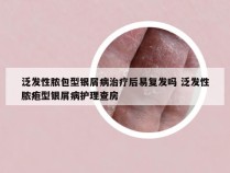 泛发性脓包型银屑病治疗后易复发吗 泛发性脓疱型银屑病护理查房
