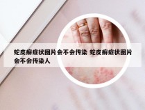 蛇皮癣症状图片会不会传染 蛇皮癣症状图片会不会传染人