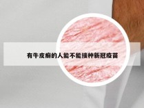 有牛皮癣的人能不能接种新冠疫苗