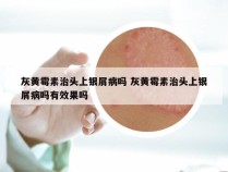 灰黄霉素治头上银屑病吗 灰黄霉素治头上银屑病吗有效果吗