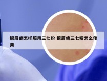 银屑病怎样服用三七粉 银屑病三七粉怎么使用
