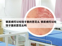 银屑病可以吃饺子里的葱花么 银屑病可以吃饺子里的葱花么吗
