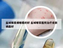 盐城银屑病哪看的好 盐城哪家医院治疗皮肤病最好