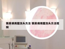 银屑病用醋洗头方法 银屑病用醋洗头方法视频