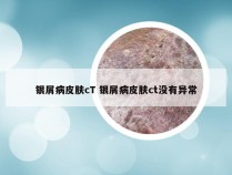 银屑病皮肤cT 银屑病皮肤ct没有异常