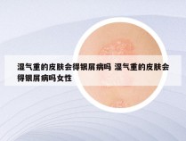 湿气重的皮肤会得银屑病吗 湿气重的皮肤会得银屑病吗女性