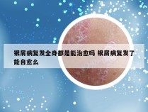 银屑病复发全身都是能治愈吗 银屑病复发了能自愈么