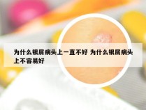 为什么银屑病头上一直不好 为什么银屑病头上不容易好